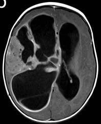 cerebral, leptomeningeal spread Right cerebral Tumor Location and MRI