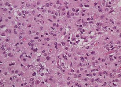 of ependymoma Anaplastic ependymoma/ glioblastoma Malignant glial tumor