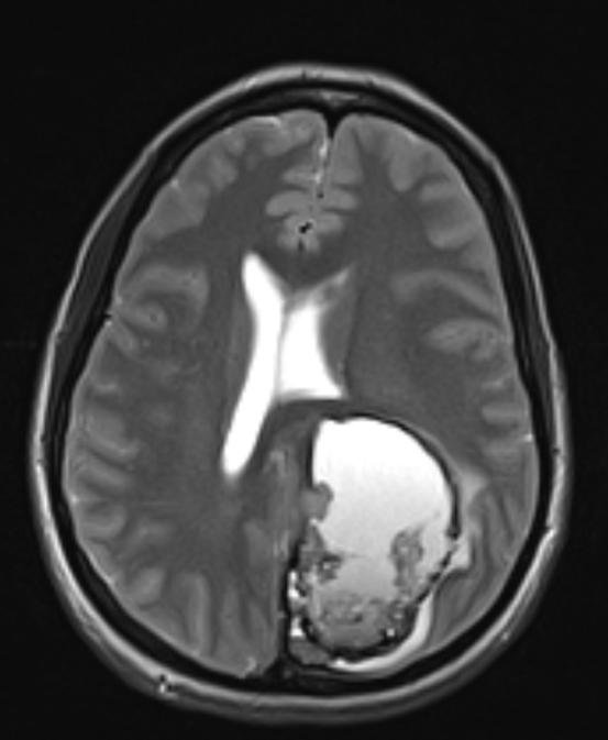 Imaging Large, predominantly cystic left parietal mass measuring 6.4 x 4.3 x 5.