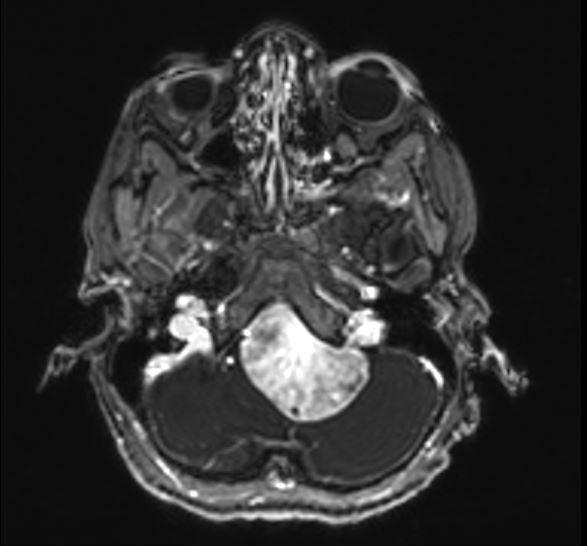 MRI Findings: T1 Axial Pre T1 Axial Post A left retrosigmoid