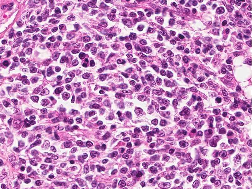 Case Study 1 These cells have distinct cell margins, scant eosinophilic cytoplasm,