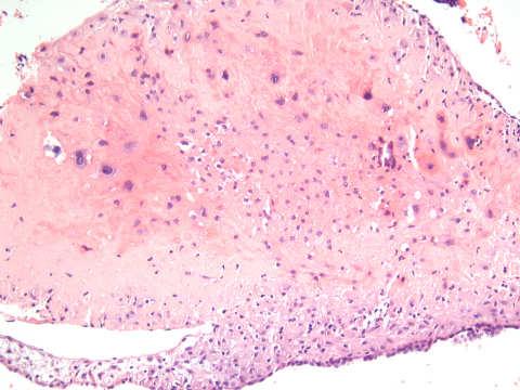 carcinoma Ichthyosis uteri Placental Site