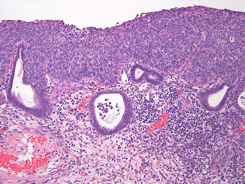 Endometrial Extension of Cervical HSIL Myometrial Invasion by Cervical Squamous Cell Carcinoma Ichthyosis Uteri Rare