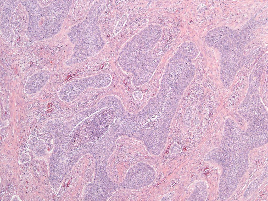 endometritis heat ablation of endometrium Squamous Squamous Placental Ichthyosis Metaplasia Dysplasia Site Nodule