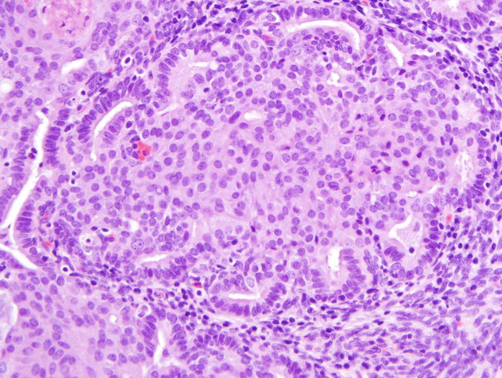 subsequent carcinoma: 5% of morules in non-atypical hyperplasia 19% of morules in atypical endometrium Interpretation: Lin et al Mod Pathol 2009; 22: 167 Based on the