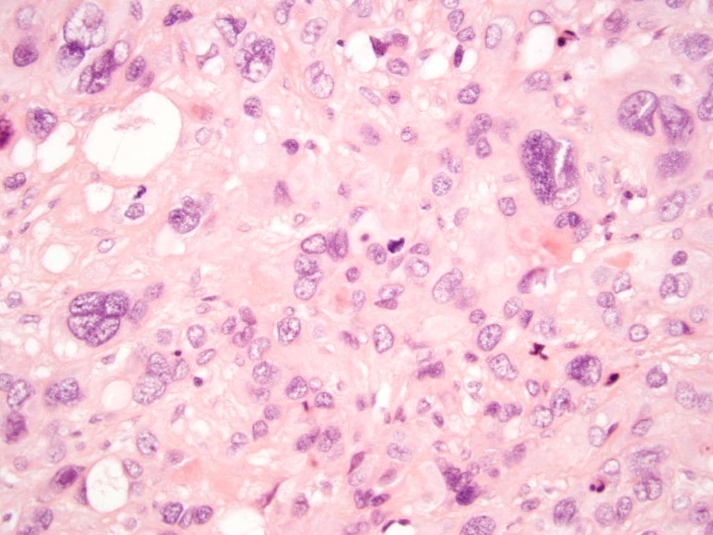 Epithelioid Trophoblastic Tumor
