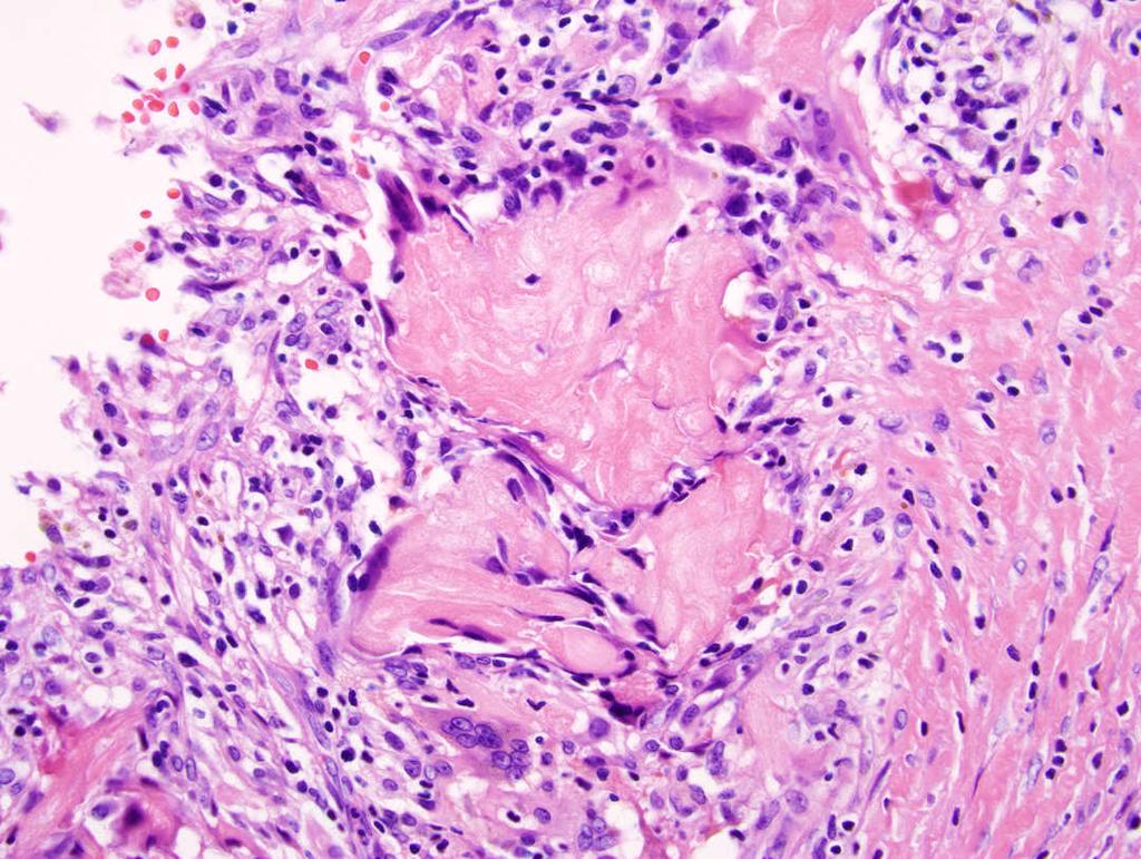 Granulomas GYN endometrioid adenocarcinoma Ruptured ovarian
