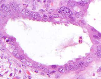 Endometriosis May Give Rise to Adenocarcinoma Atypia May be Seen in Transition to Cancer