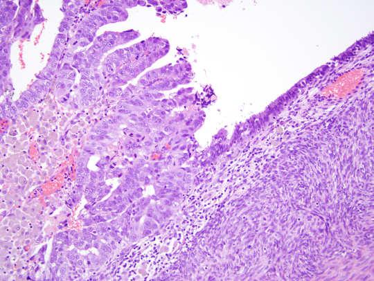 Serous carcinoma in endometriosis Clear