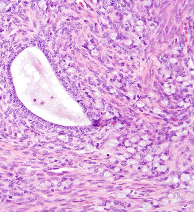 Endocervical adenocarcinoma, intestinal type Non-GYN mucinous