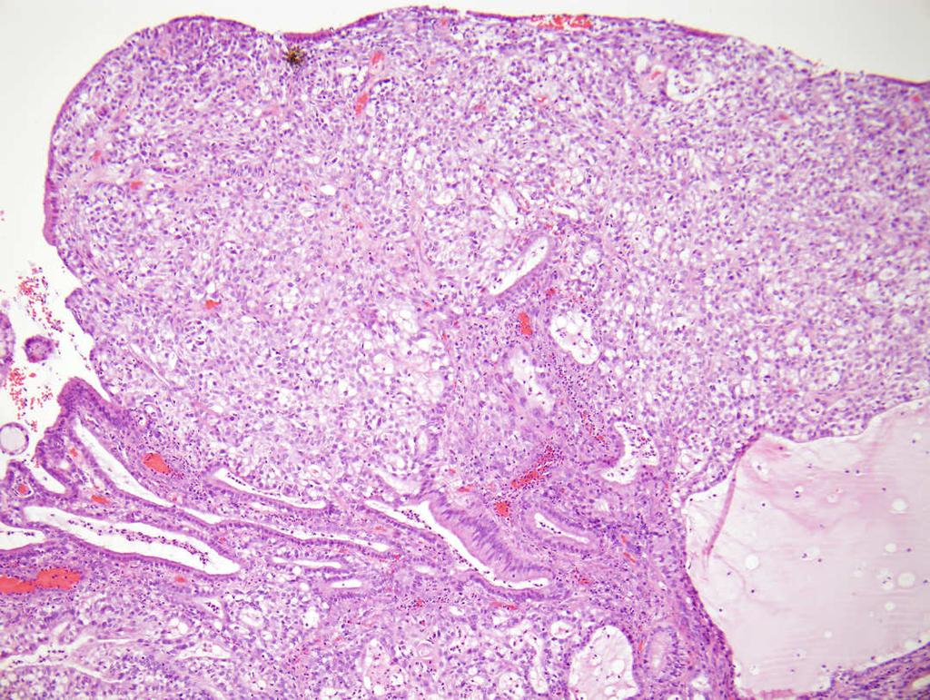 Atypical MGH of Endocervix Solid MGH of Endocervix Solid / sheet like pattern (mimic clear cell carcinoma) Reticular pattern ( mimic yolk sac tumor)