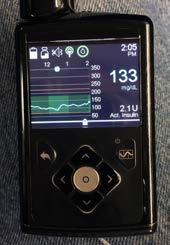 Steps to a Better Artificial Pancreas Early AP System Approved More accurate CGM devices More rapid insulins Further refinements in