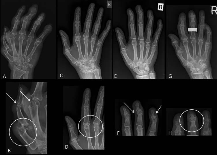 may be a surrogate for tophus resolution, imaging allows the direct visualisation and measurement of tophi as they resolve, even when this cannot readily be detected by clinical examination.