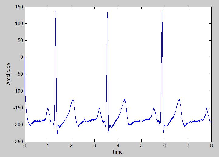 E. Butterworth Band-reject filter: After careful observation of FFT analysis of Noisy ECG signal, it is found that there is a band of frequency around 39 Hz and 60 Hz.