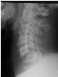 In NEXUS, 34,069 patients at risk for c spine injuries were evaluated, 818 had a cervical spine injury on x ray The NEXUS criteria correctly identified all but 8 patients That s 99.