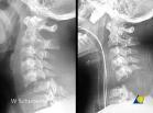 Intoxication OLD PROBLEMS Fear of a rare animal Cervical spine injuries fortunately not that common Overall prevalence of c-spine