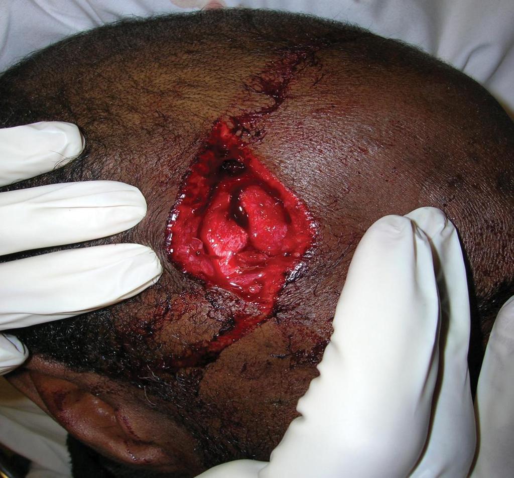 Injuries to the Skull and Brain Scalp injuries Lots of blood