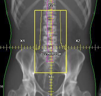 Lower Spine field traditional CSI Lower