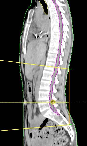 with the inferior border of upper spine
