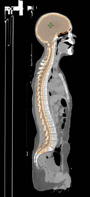 Contouring - Targets Physician will draw Spinal cord Spinal canal PTV CSI Expansion from Spinal Canal: 1.5cm left and right, 0.