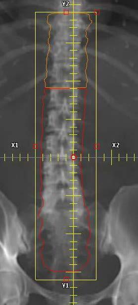 Treatment Planning Lower Spine Place