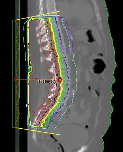 Treatment Planning Lower Spine Dose distribution after optimization Need to add