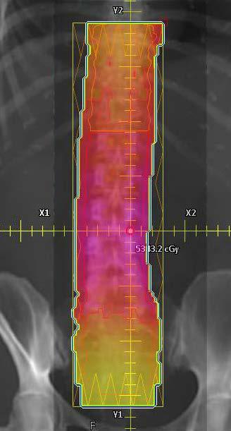 Treatment Planning Lower Spine This is the fluence before we manually step down the dose in the overlap region To step down the dose, measure transmission factor in the superior portion of the PTV