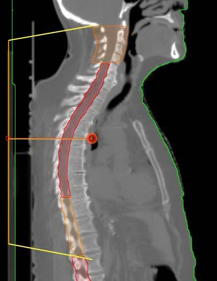 Treatment Planning Upper Spine Field should