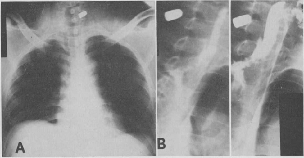 SYMBAS ET AL. common symptoms and signs of perforation of the abdominal esophagus, and not infrequently of the lower thoracic esophageal segment, and may be mistaken for a perforated peptic ulcer [GI.