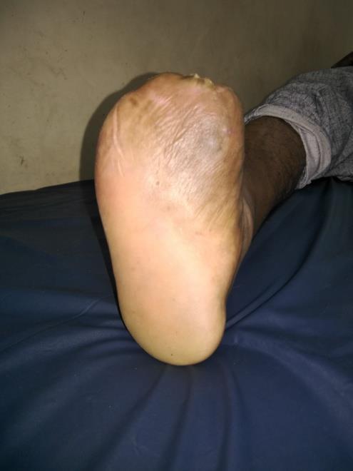 Note the decrease in diameter of the wound. The surrounding callus that gets build up is regularly debrided. any iatrogenic ulcers from offloading.