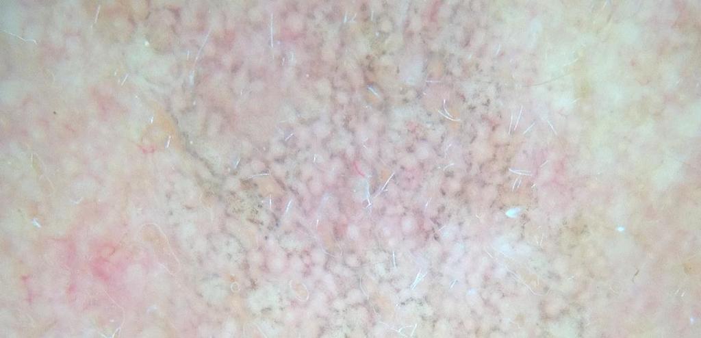 Lentigo Maligna Chronically UV exposed skin