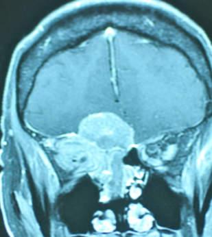 WHEN NOT TO OPERATE Anatomic factors Brain Eloquent part of cortex Superior sagittal