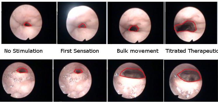 Mechanism of Action: Multi-level Effect Palate Tongue-