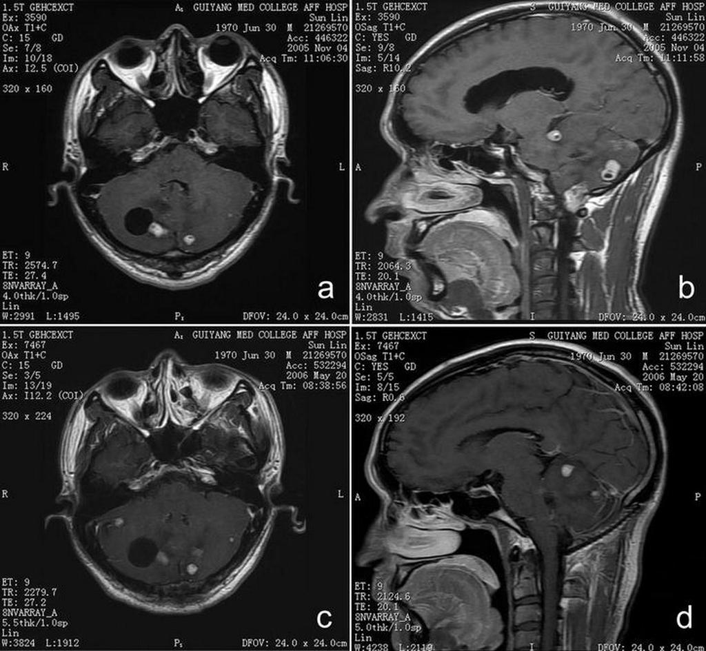 Central nervous system hemangioblastoma 7907 roots, stereotactic radiosurgery Gamma knife treatment should be performed because the lesions are not sensitive to conventional radiotherapy.