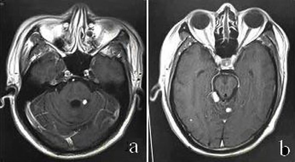 rebellar hemisphere. c. Reinspection of the right cerebellar hemisphere after the Gamma knife operation: tumors appeared to be lobulated. d.