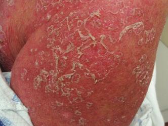 Near-confluent erythema on the upper arm with associated thick, flake-like scale.