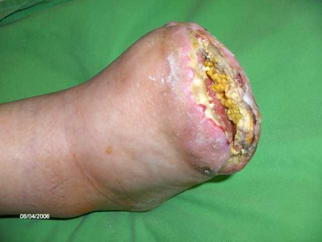 treatment, local resection of the foot