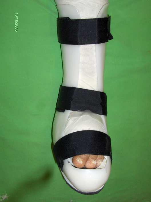 Custom made AFO Tight fixation of the ankle, splinting of the foot More lightweight