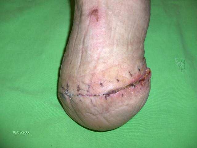 prostheses and wound treatment Surgical