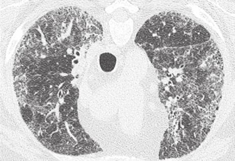 slow disease progression and preserve lung function in patients with IPF (14-16). In spite of this progress, there remain unresolved challenges in the diagnosis and management of IPF.