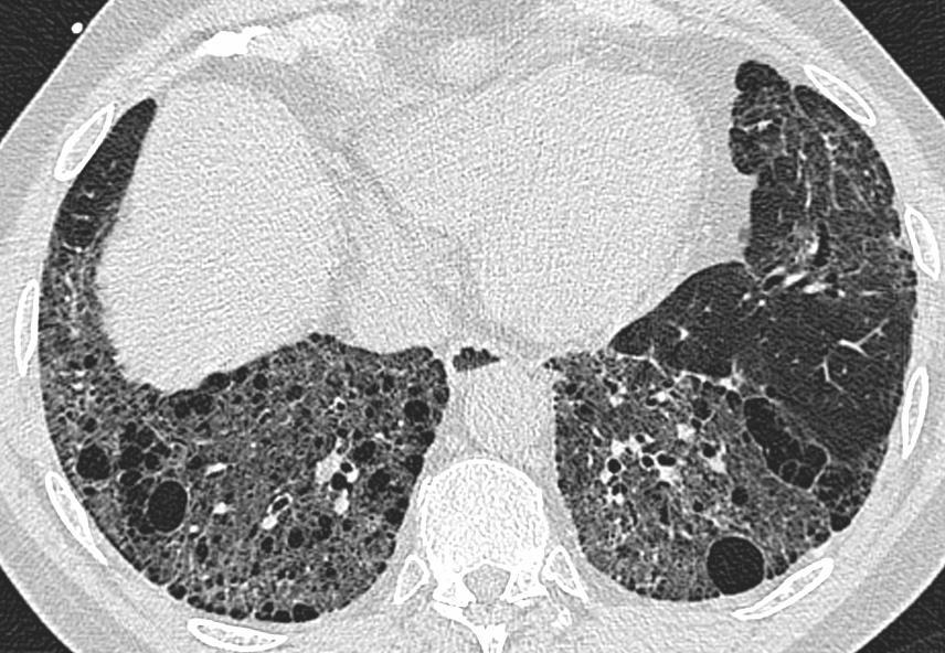 Lung biopsy: Fibrotic NSIP