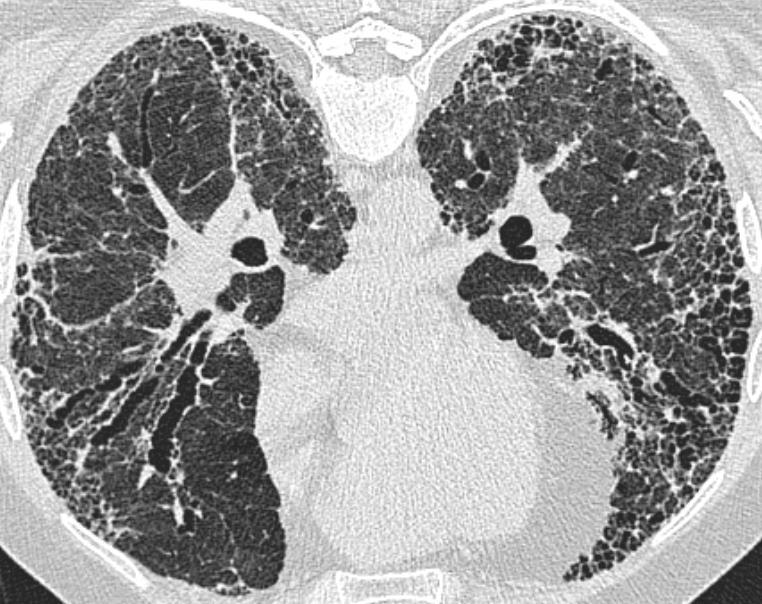 Identification of traction bronchiectasis on HRCT False positive identification Within honeycombing Dilated bronchi within OP / DAD
