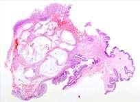 Polypoid mucosal prolapse lower rectal/anal most common: inflammatory cloacogenic polyp epithelial