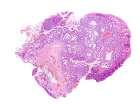 polyp 4 cases of adenomas of the lower rectum causing