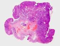 Epithelial misplacement vs invasive carcinoma There is a very