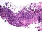 lesions: oesophagus, stomach and rectum Abnormal stromal cells associated with ulceration Isaacson PG.