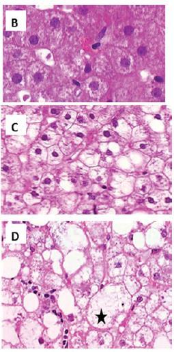 Hepatology. 2012 Nov 1;56(5):1751-9 Recognising ballooning (B) Normal hepatocytes, ballooning, grade 0. Cytoplasm is pink and granular and liver cells have sharp angles. (C) Ballooning, grade 1.