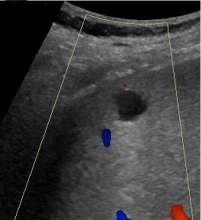 Liver Cyst - US Anechoic = black Increased through transmission (white