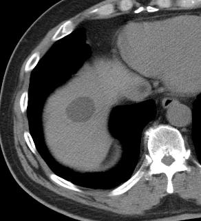 Liver Cyst - CT <10 Hounsfield units Same