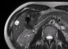 Liver Cyst MRI